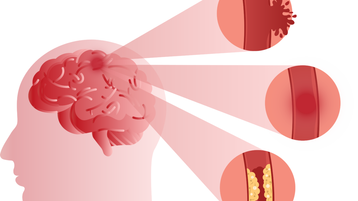 STROKE – MINDENT TUDUNK RÓLA?